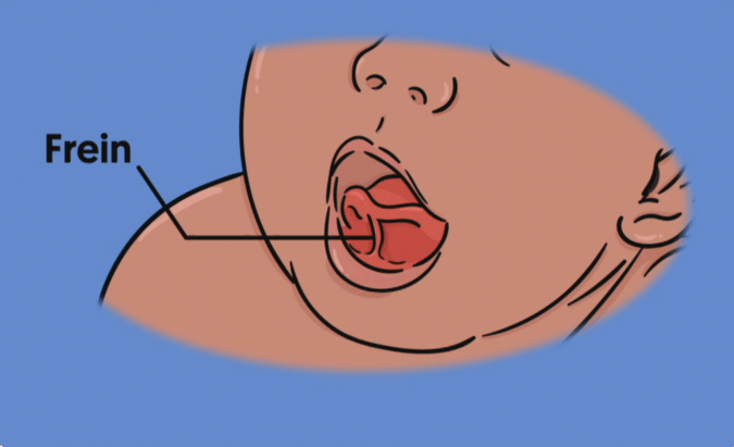 frein de lèvre frein de langue bébé